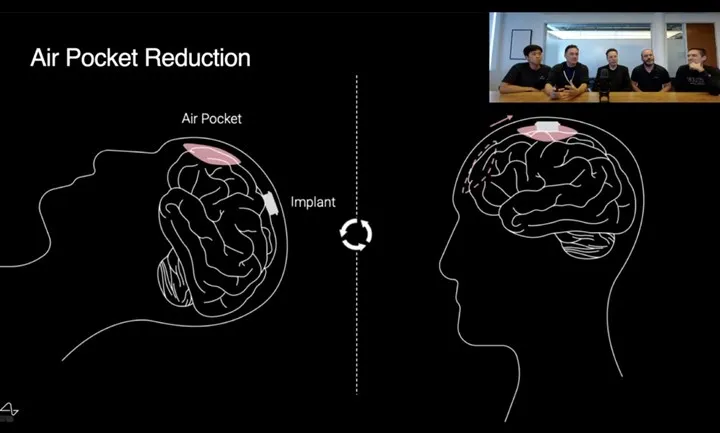 Neuralink 1000 beyin çipi 